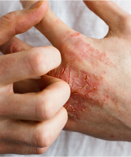 main homme avec maladie de peau